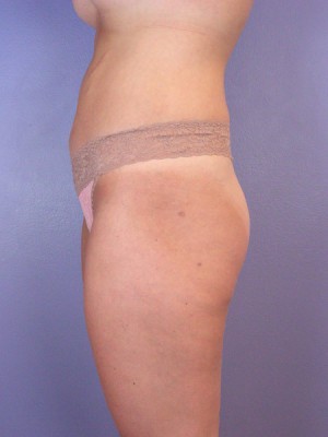 Liposuction