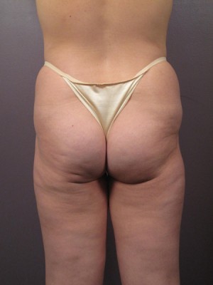 Liposuction