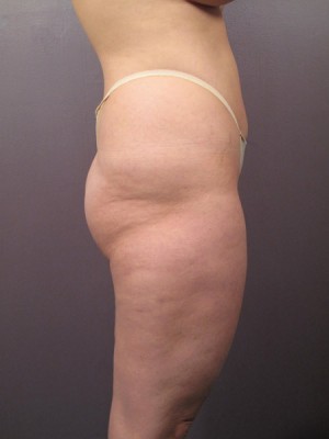 Liposuction