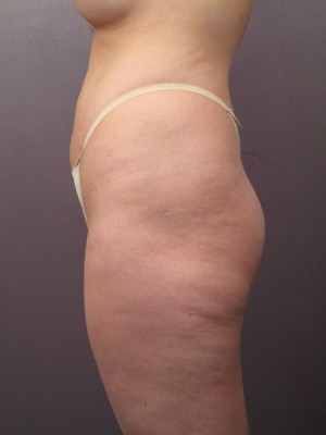 Liposuction