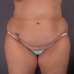 Liposuction