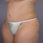 Liposuction