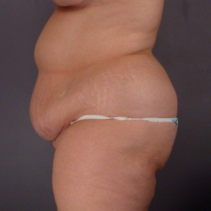 Liposuction