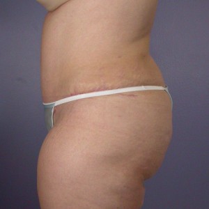 Liposuction