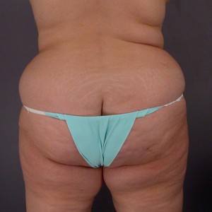 Liposuction