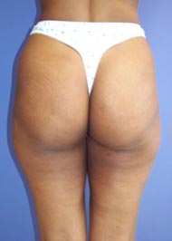 Liposuction