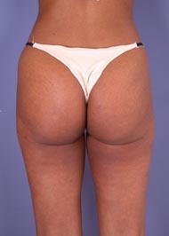 Liposuction