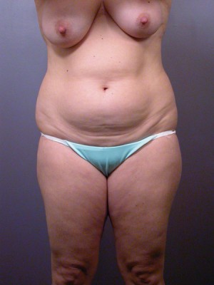 Liposuction