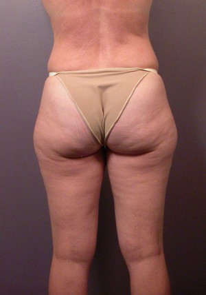 Liposuction