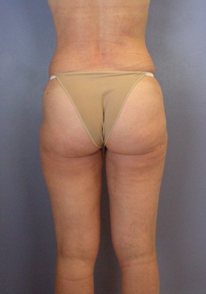 Liposuction