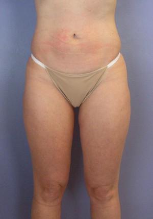 Liposuction