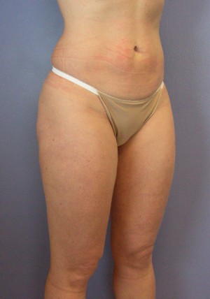 Liposuction