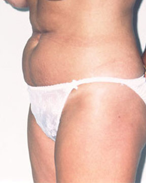 Liposuction