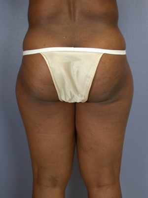 Liposuction