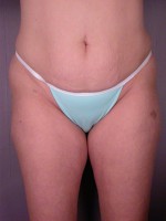 Liposuction