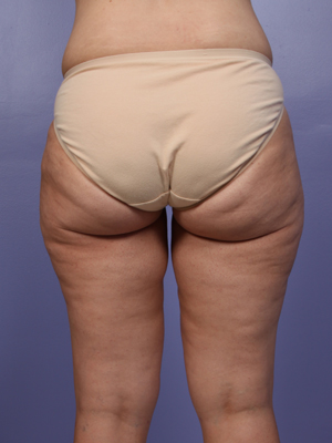 Liposuction