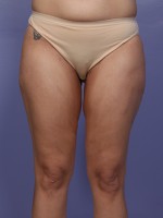 Liposuction