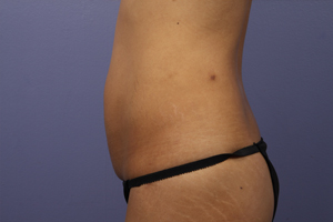 Liposuction