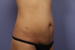 Liposuction