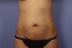 Liposuction