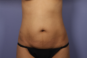 Liposuction