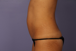 Liposuction