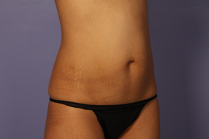 Liposuction