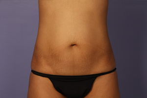 Liposuction