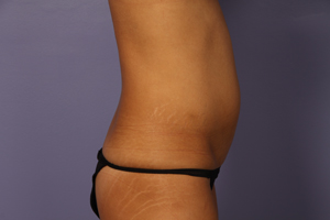 Liposuction