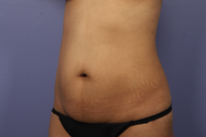 Liposuction