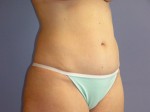 Liposuction