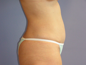 Liposuction