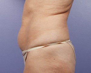 Liposuction