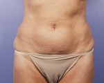 Liposuction