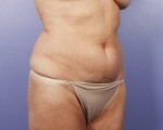 Liposuction