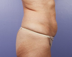 Liposuction